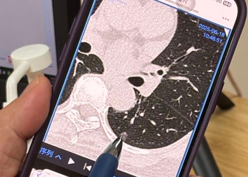 肺结节考虑肺原位癌、微浸润癌，都说是“癌”了，为什么还能继续观察？首先，发现肺结