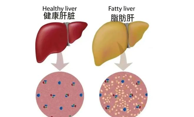 一个中成药，给肝脏化瘀、化堵，你都知道吗？现代人饮食结构中高脂高糖的食物增多