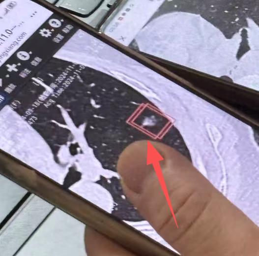 肺结节密度在-400以上，就特别紧张，担心这个结节以后一定会变糟，危险性还特别高