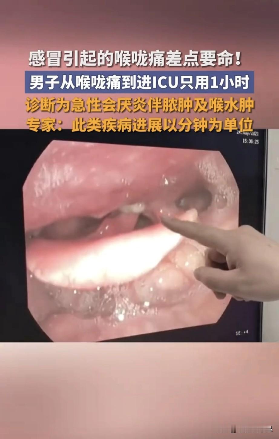 刚刷到一个新闻，直接吓得我从床上弹起来！西安一个大哥，前一天还好好的，只是喉咙有