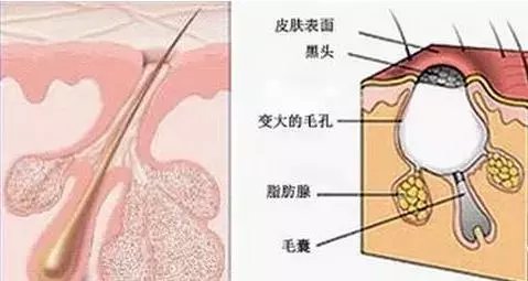 头皮长痘痘是怎么回事?