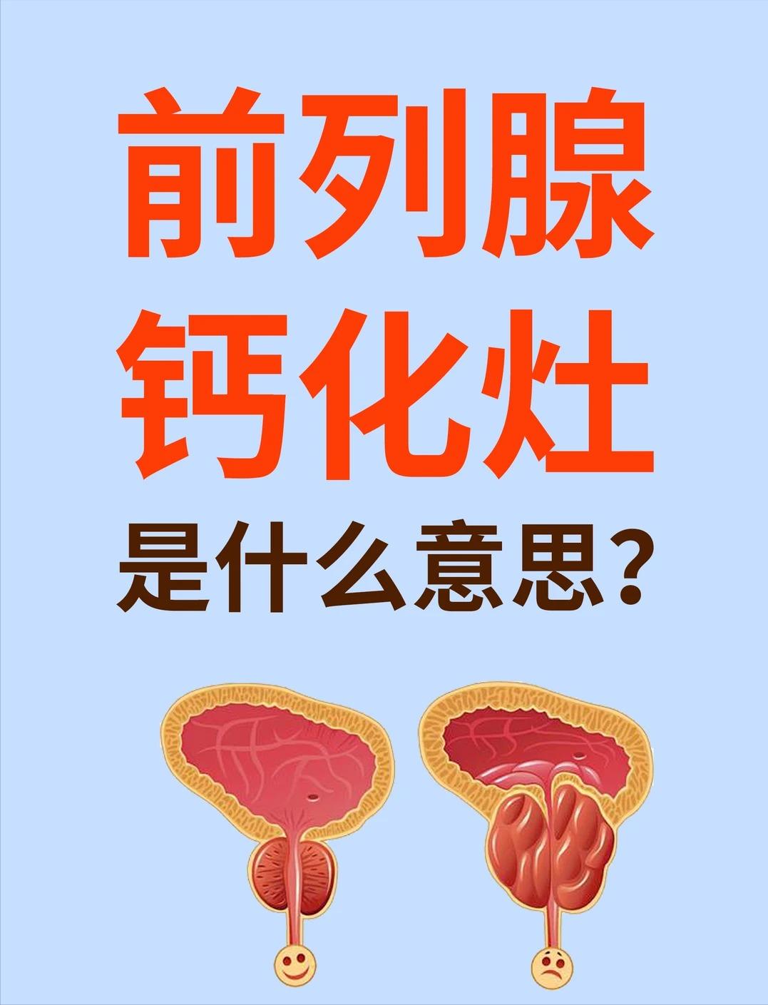 健康科普：前列腺钙化灶是什么意思？