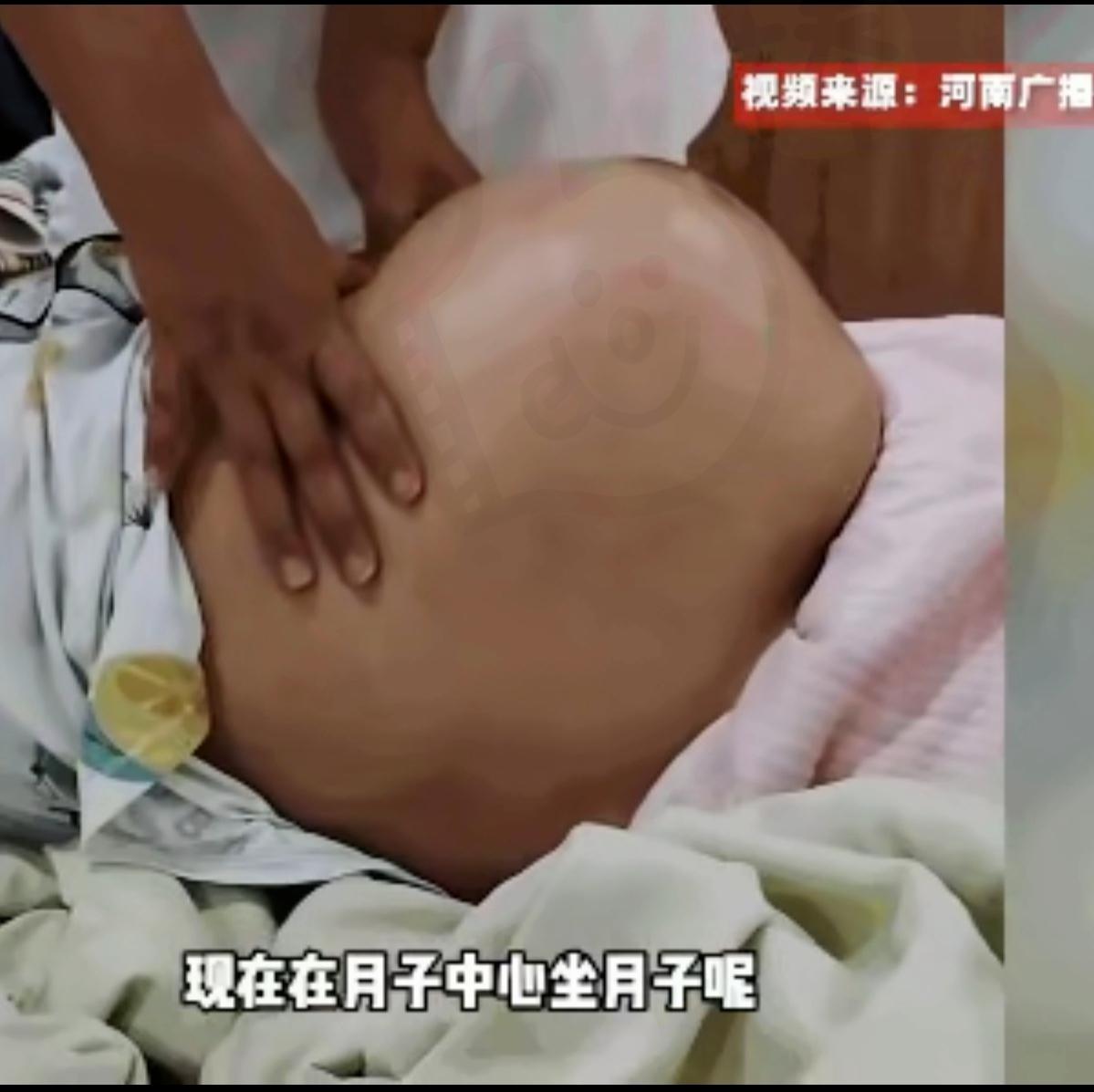 生完娃10天肚子越笑越鼓？剖腹产哪是“剖完就没事”！郑州宝妈生