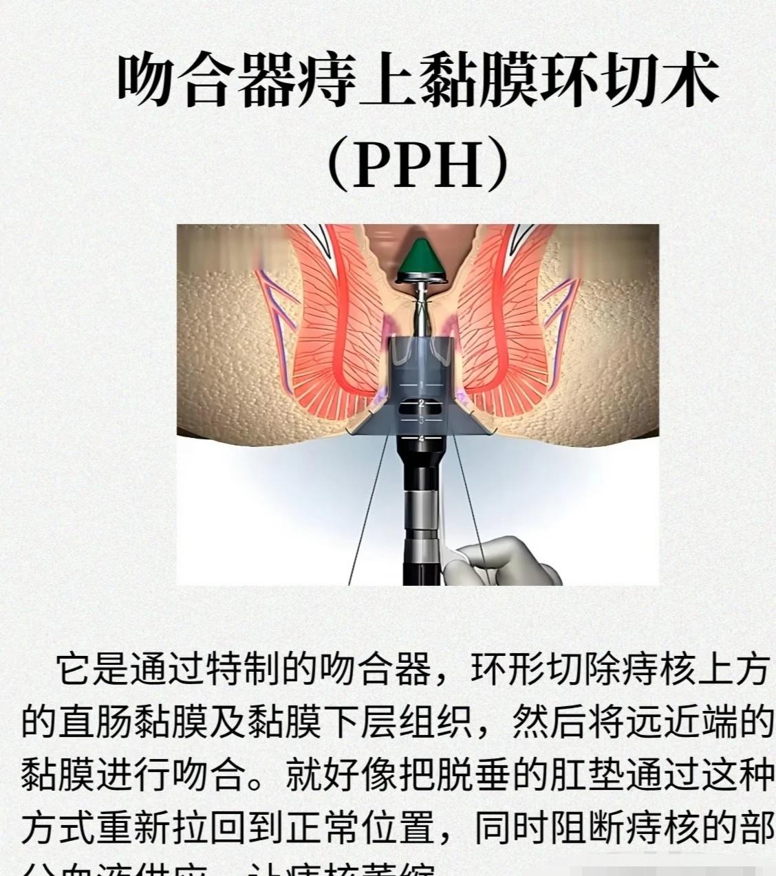 谈一谈痔疮手术中号称微创的PPHPPH手术，全称吻合器痔上黏膜环切术，1998