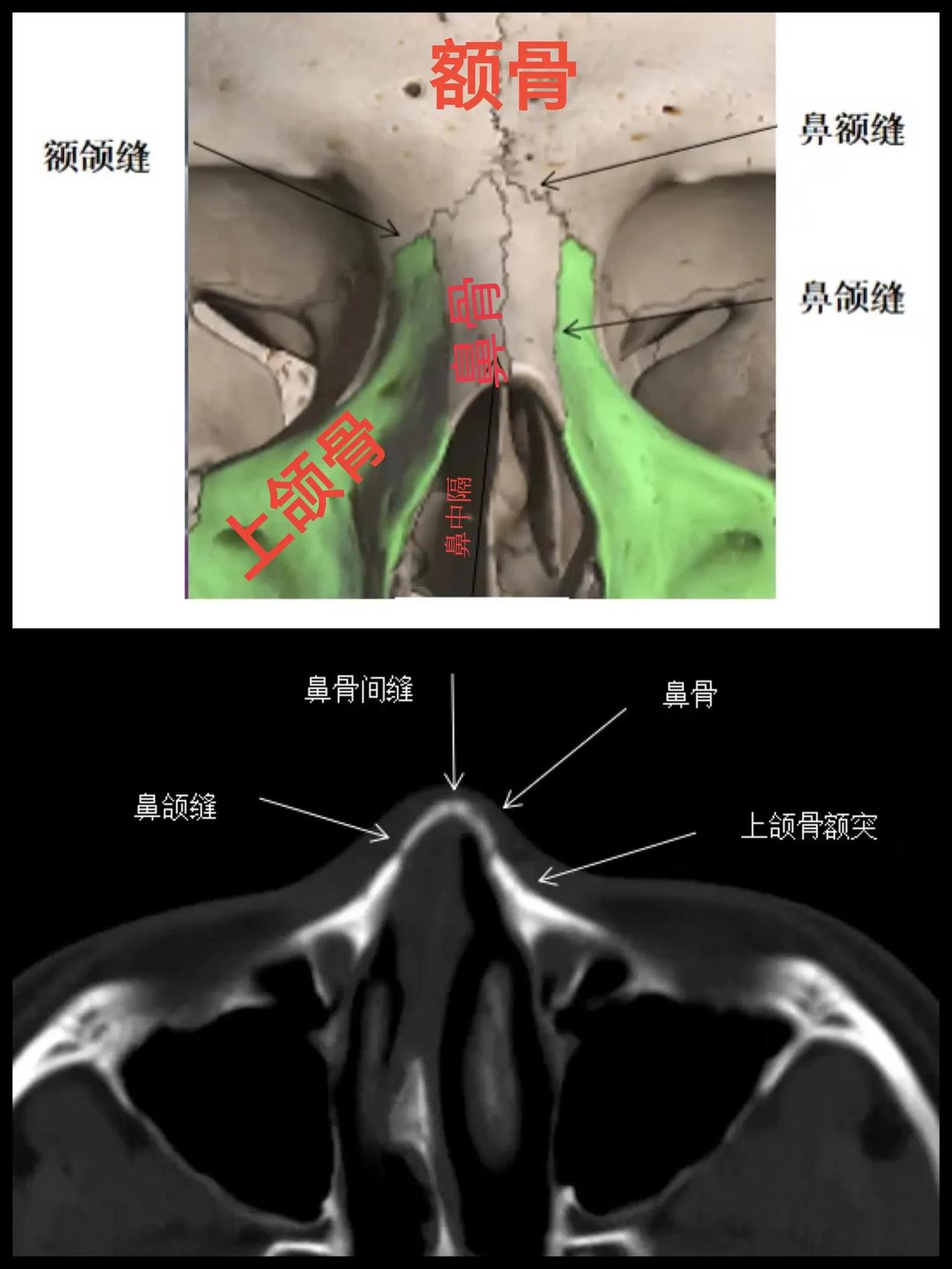 鼻骨！[无奈吐舌]这件事，很多人不明白！生活中，有时候鼻子受伤，鼻梁肿胀，鼻孔