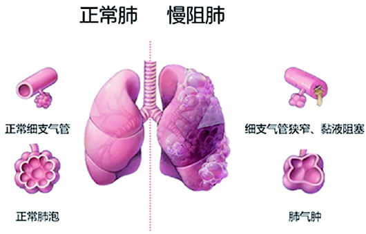 专家提醒: 六种方式可预防慢阻肺