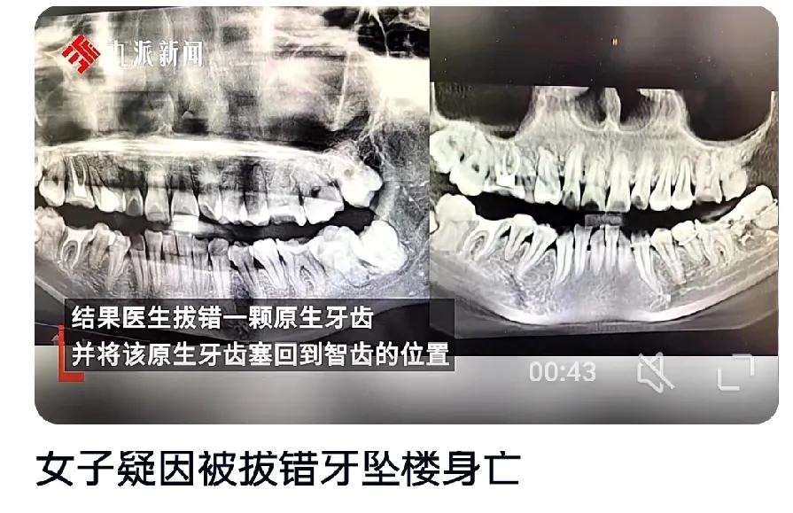 拔错牙后坠楼身亡：当白衣天使变成刽子手，病历成了橡皮泥一条生命的消逝，撕开