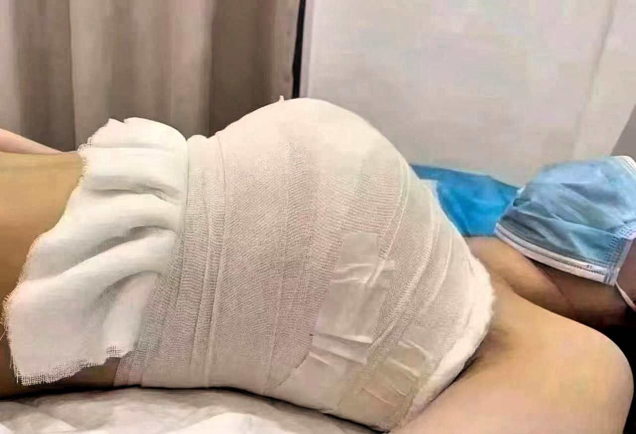 天塌了～刚隆胸手术7天就发现怀孕了，还是双胞胎！昆明张女士的遭遇，让不少