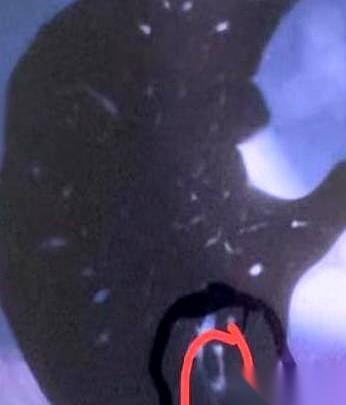 “医生，他们说我这个……可能是肺癌。”诊室的门一关上，空气都好像凝固了。她才3