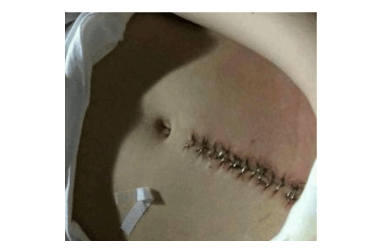 北京剖腹产要怎么护理? 宝妈在意的伤疤怎么办