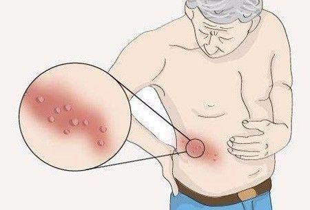 “缠腰火龙”惹上身以后, 真的会夺走人的性命吗?
