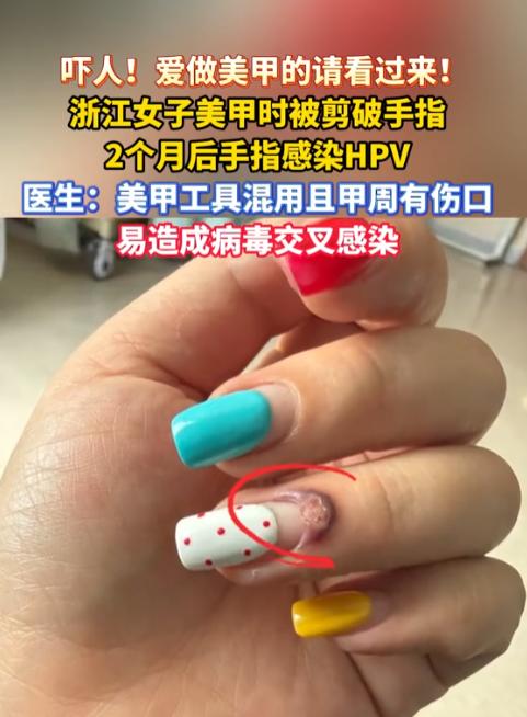 离谱！杭州女子美甲修死皮，竟被未消毒工具剪破手指！本以为是针尖大的小事，哪知两个