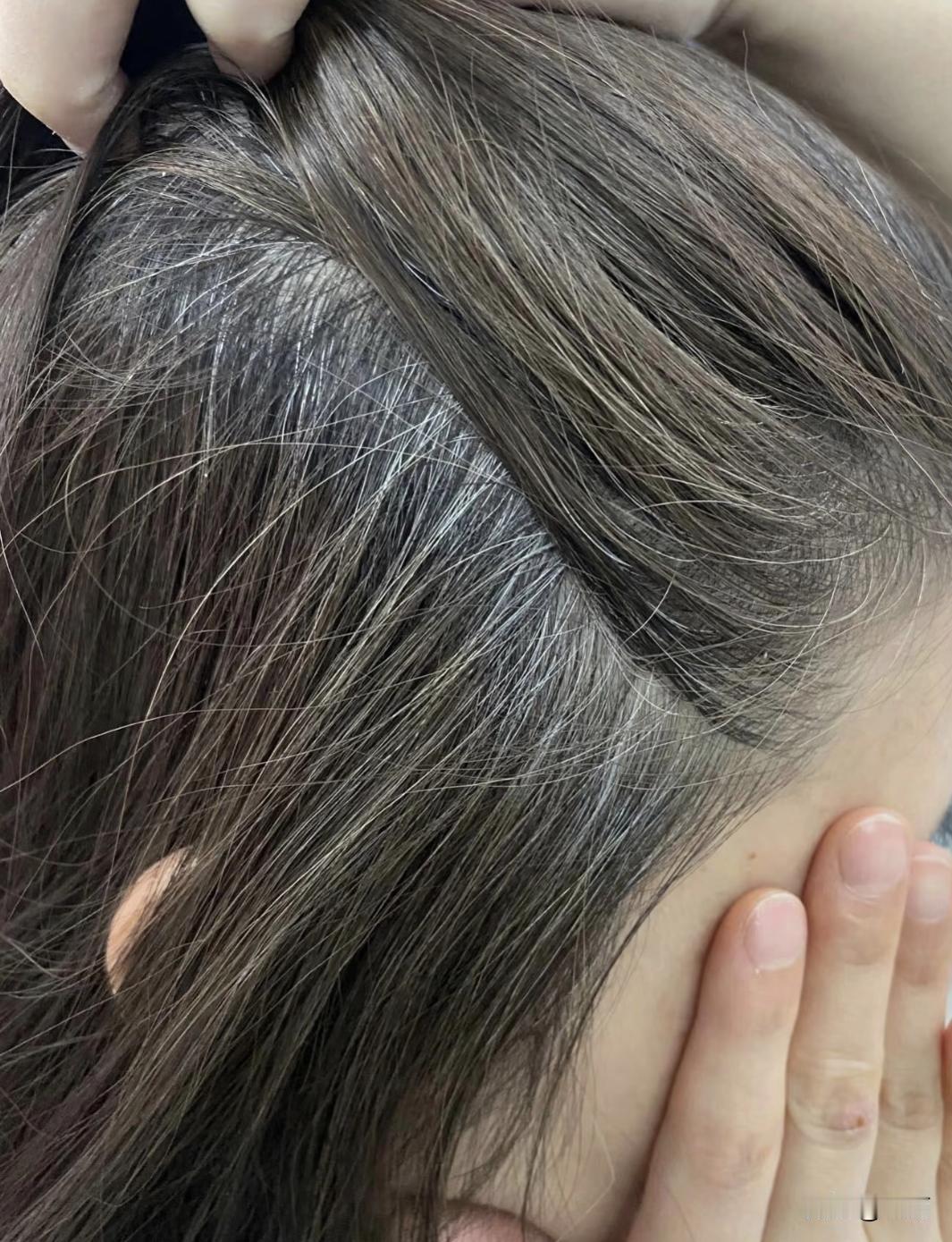 87年的我已白发苍苍[捂脸哭]今天刷视频说年纪轻轻就有白头发居然是缺钱了！想想还