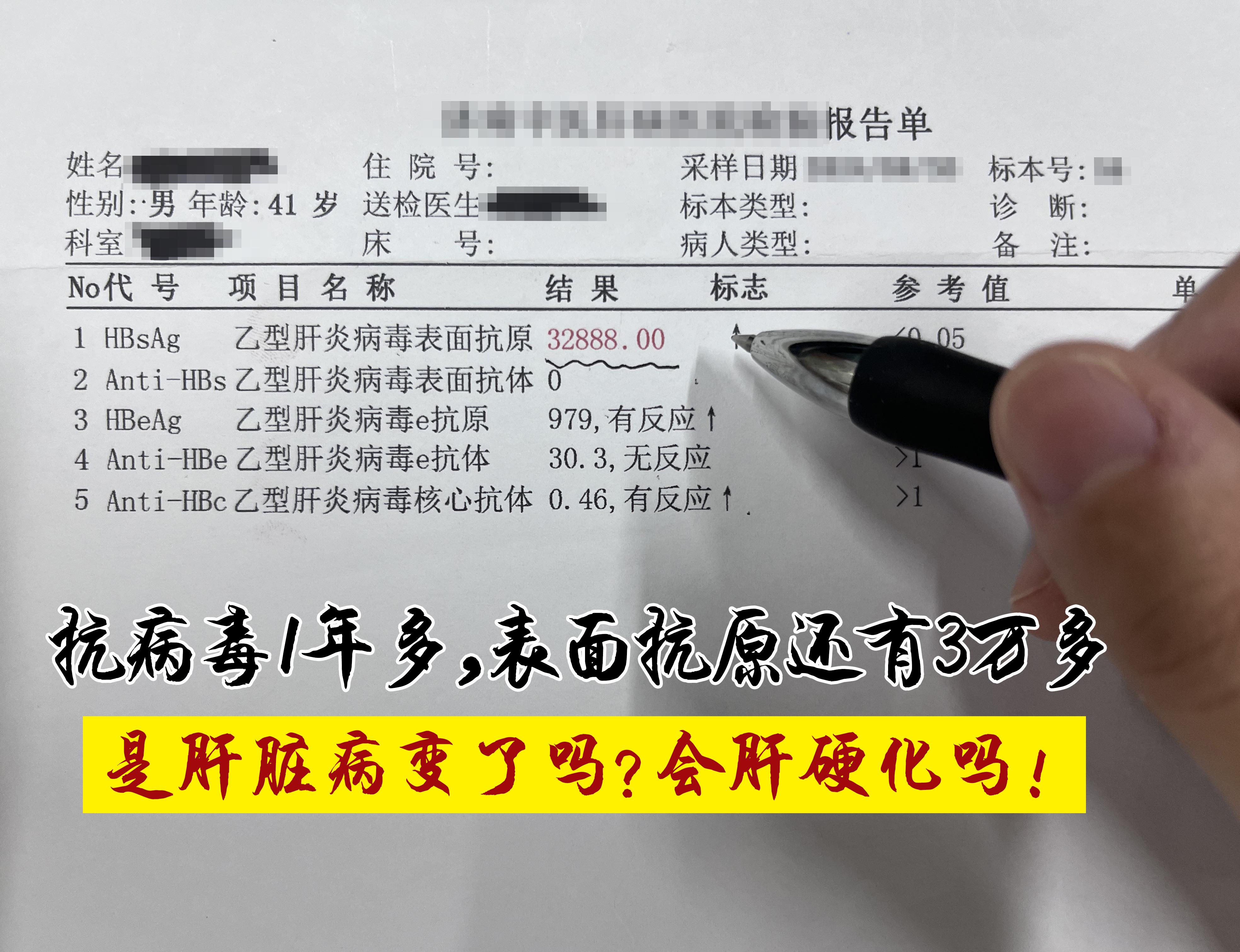 前段时间接诊了一位小伙，抗病毒治疗1年半，大三阳，乙肝表面抗原仍高达3...