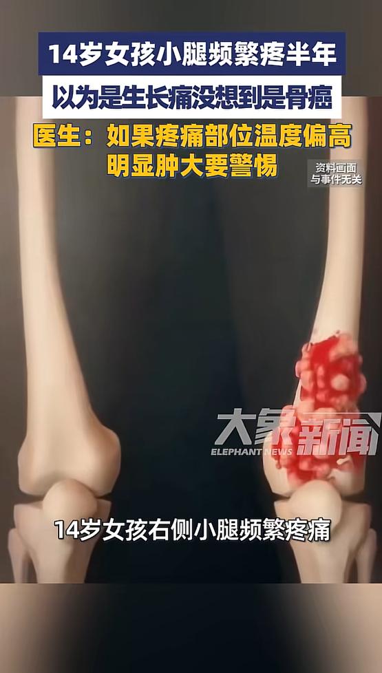“悲剧还是发生了！”河南郑州，一女孩小腿频繁疼痛，家长以为是生长痛，没当回事，没