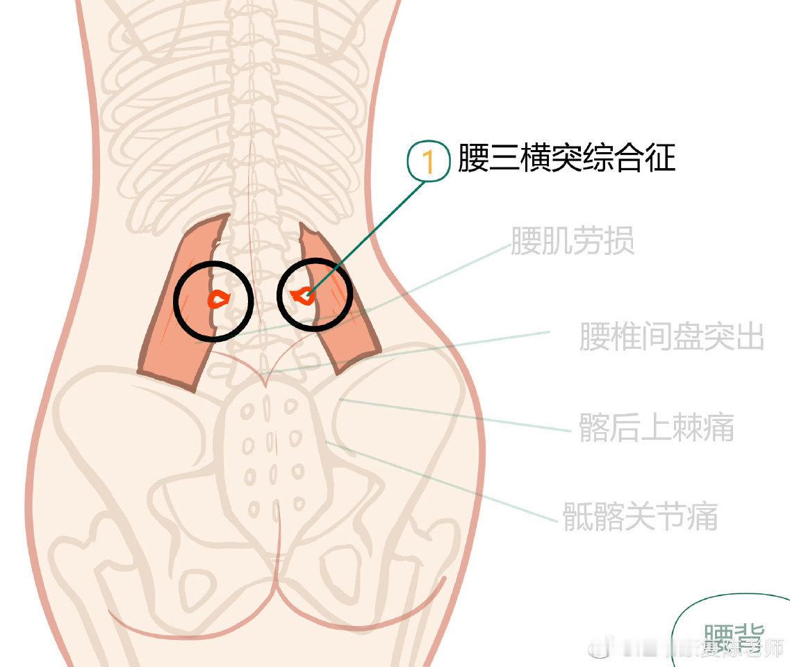 腰痛康复来复习一波腰背知识——腰肌劳损、腰椎间盘突出、骶髂关节、筋膜炎，它们的