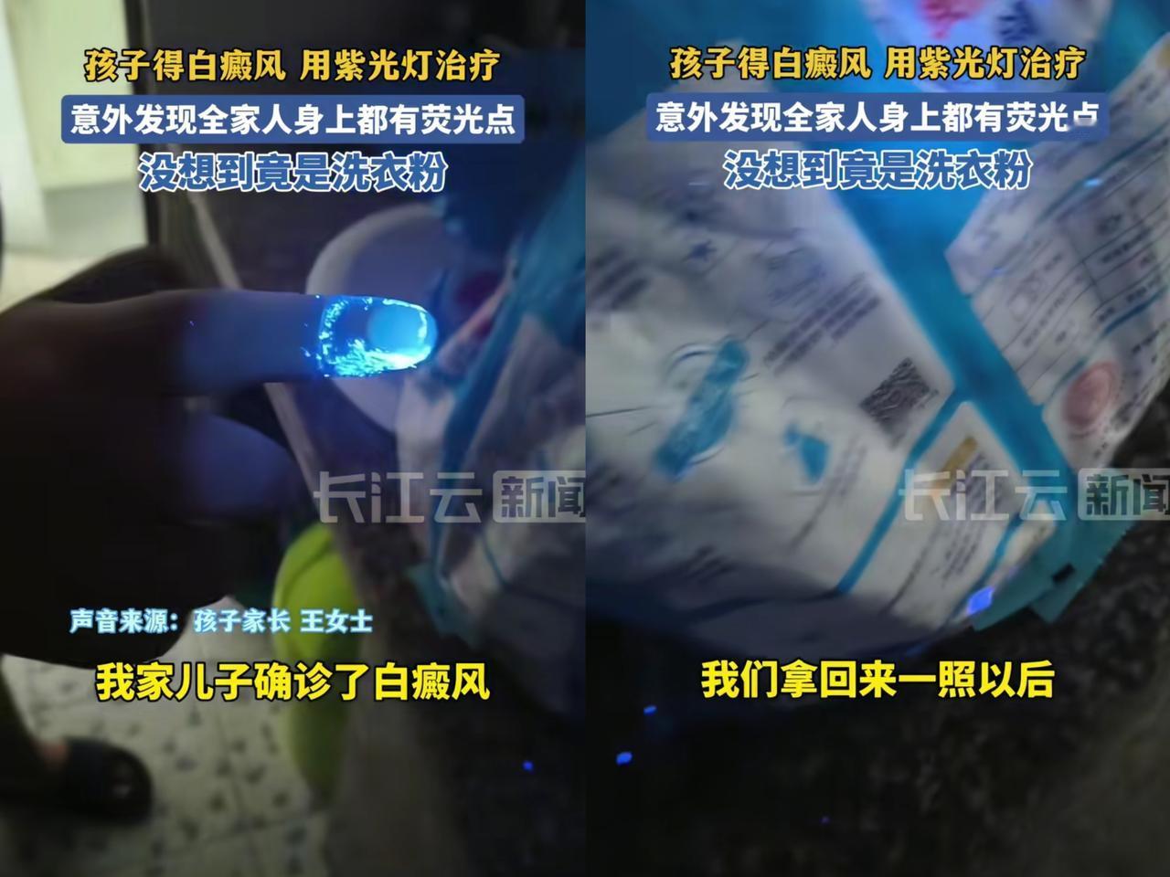 “彻底解释不清了!”浙江温州,王女士儿子确诊白癜风,医院开的紫光灯一照,全家