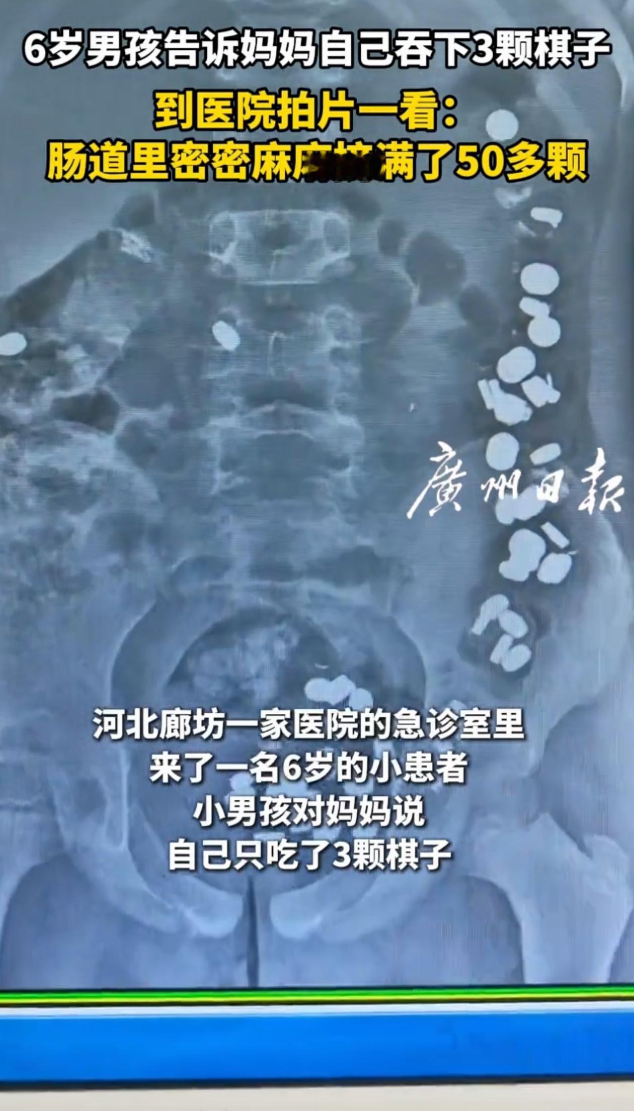 万万没想到！河北廊坊，女子带着6岁娃去看急诊，医生问怎么了，女子说他家娃吃了3颗
