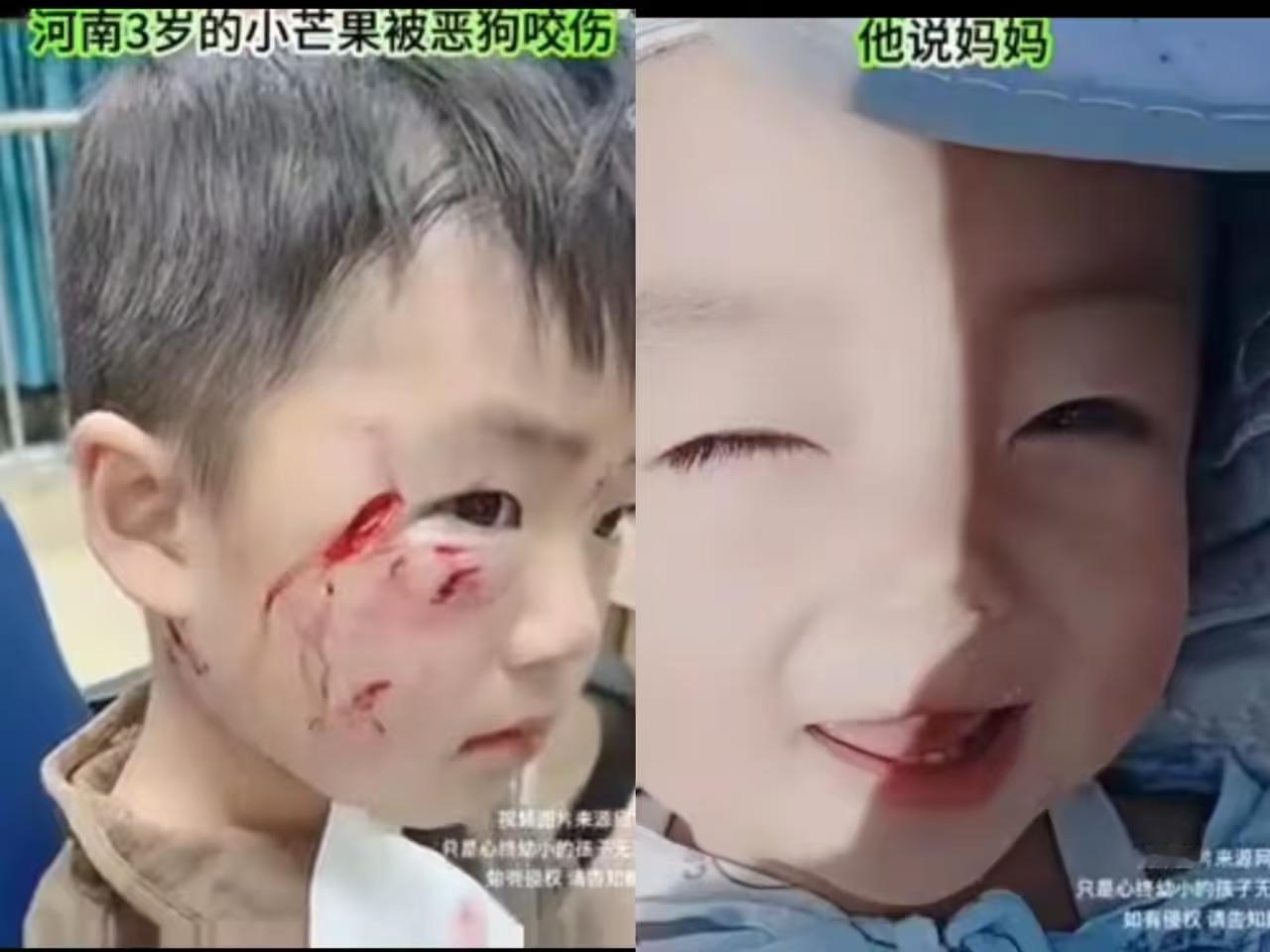 3岁幼童没能挺过第五针疫苗，被恶犬咬伤18天后不幸离世，不是栓绳不栓绳的问题，狗