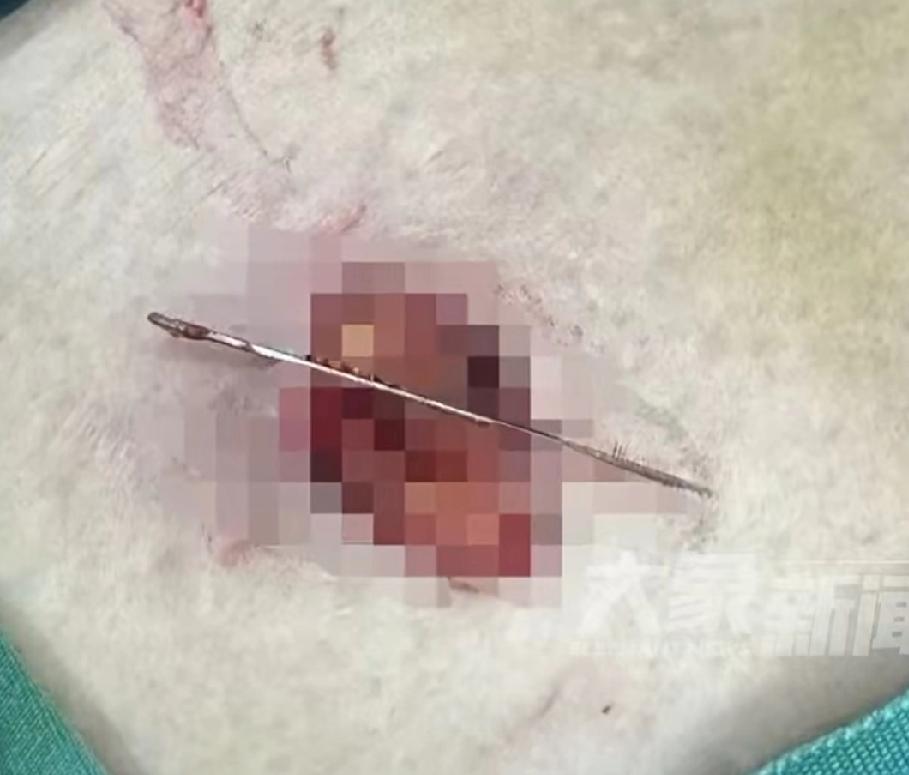 近日陕西西安60岁的张某缝完被子后，随手把一枚缝衣针别在了腰间的衣服上，转身去照