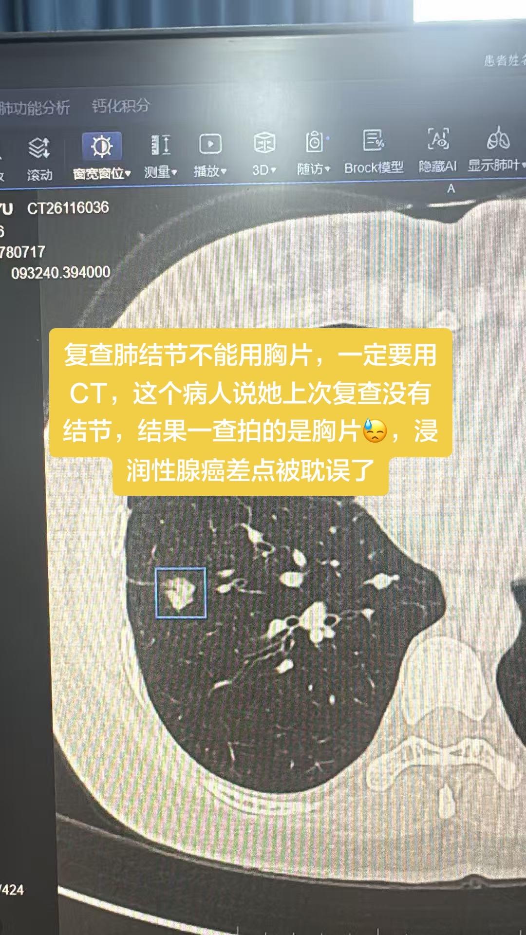复查肺结节不能用胸片，一定要用CT，这个病人说她上次复查没有结节，结果...