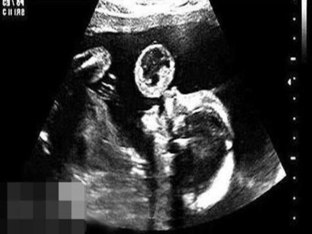 5个月孕妇产检时, 胎儿吐出一个泡泡, 医生的一番话让孕妈无法接受