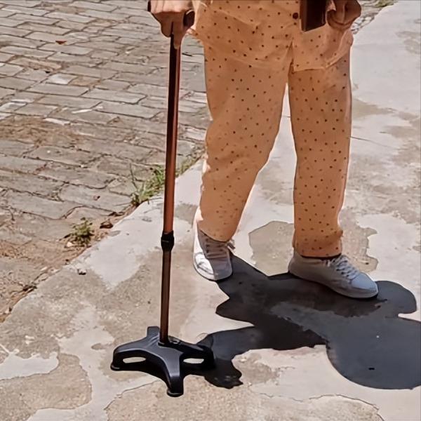 偏瘫最怕出现这两种情况！第一种情况：肌张力增高肌张力增高之后你会发现，患侧