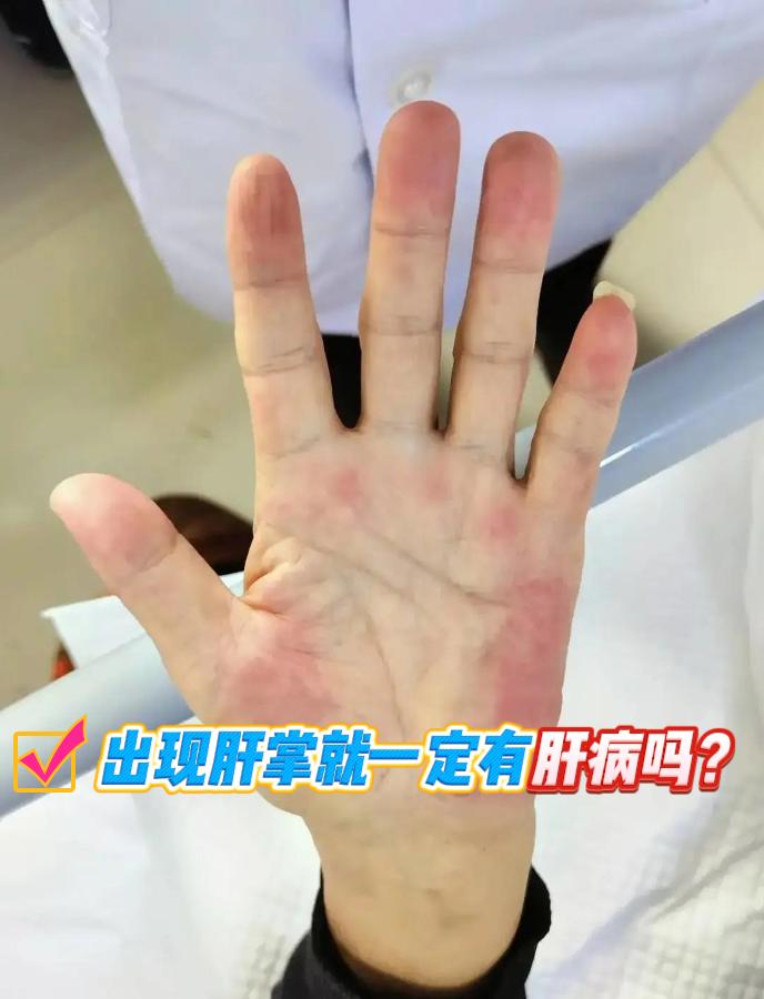 出现肝掌就一定有肝病吗？    最近经常有粉丝问我肝掌和肝病的相关问题...