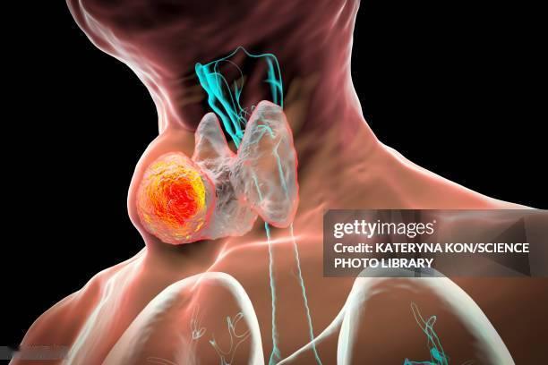 河南一家五口四人罹患甲状腺癌的消息，着实令人揪心不已。三十出头的弟弟率先确诊甲状