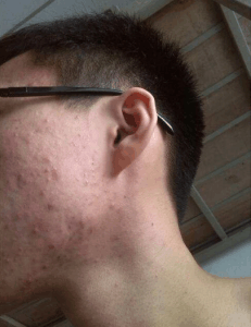 痘印一般多久会消失