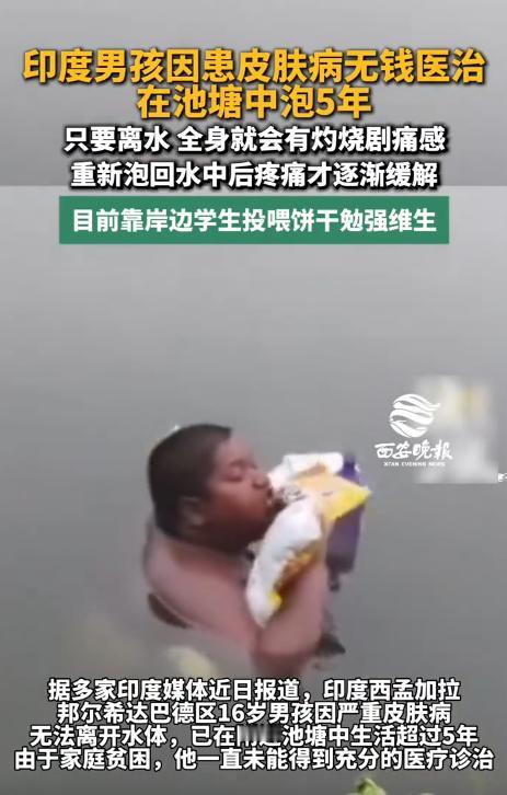 印度，一16岁男孩因患罕见皮肤病，只要离开水全身就灼烧剧痛，因家贫无钱医治，已在