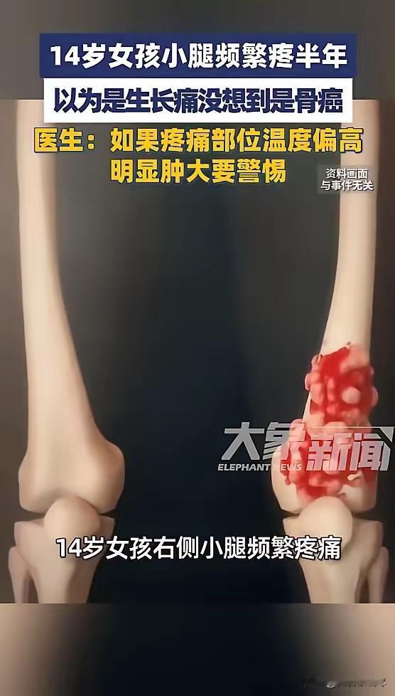 “悲剧还是发生了！”河南郑州，一女孩小腿频繁疼痛，家长以为是生长痛，没当回事，没