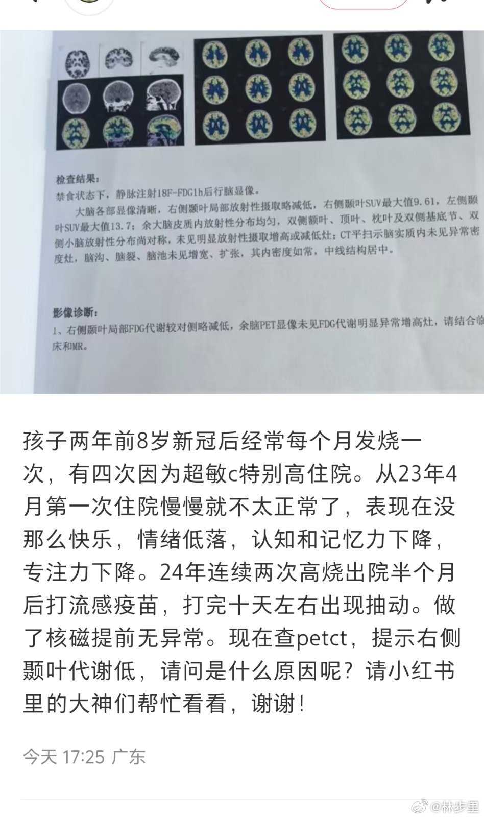 8岁，新冠后经常每个月发烧一次。才8岁……难以想象，人生还那么长，那么容易生病，
