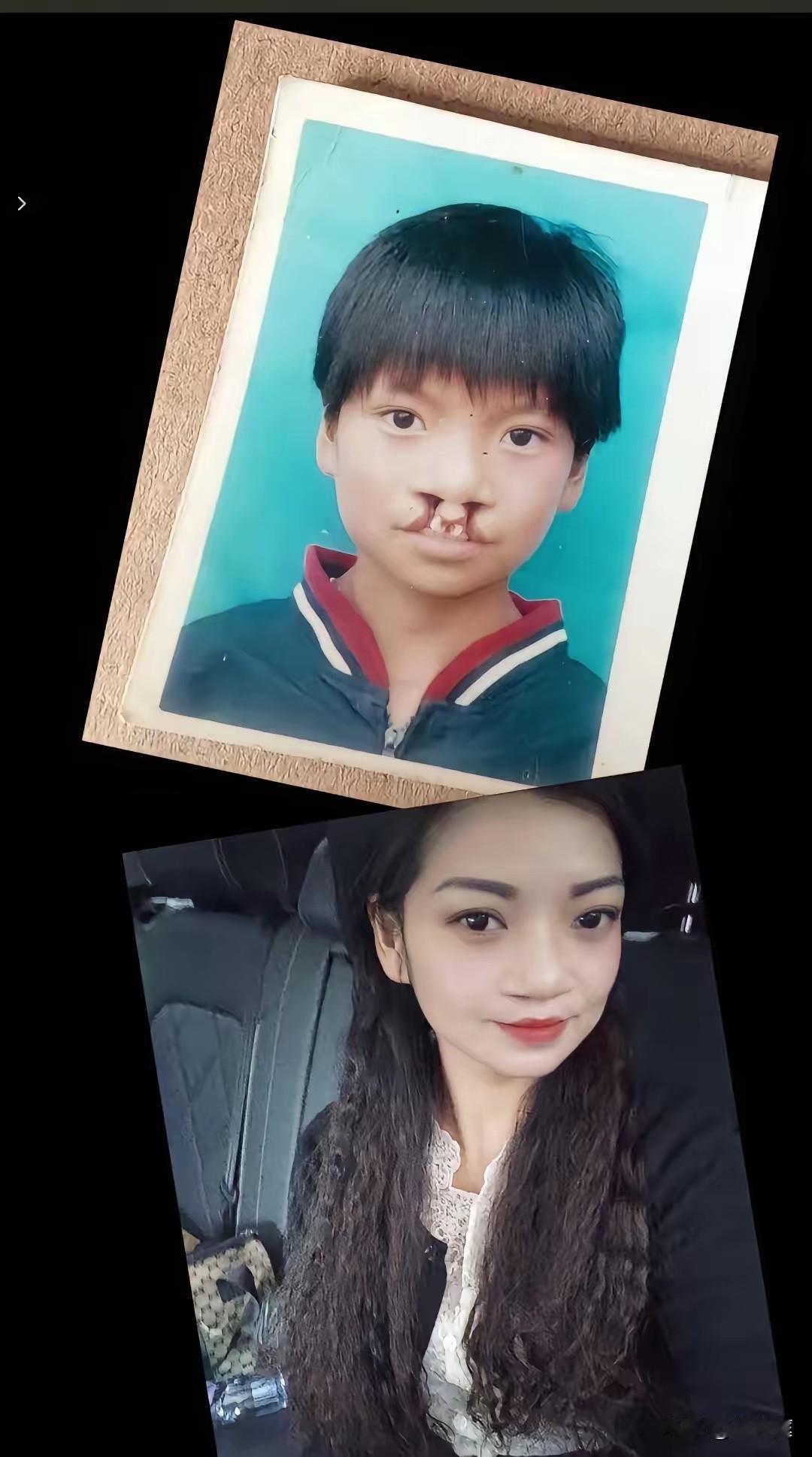 嫣然天使儿童医院最牛的点在于，成立的14年里共完成了11000多例手术，其中就有