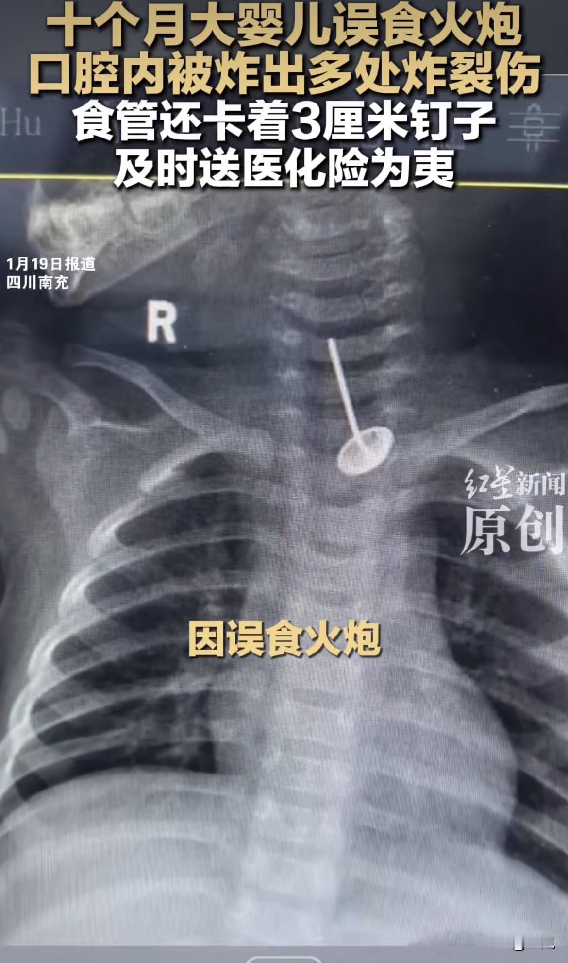 十个月大的婴儿，嘴里炸了一颗火炮。这还不是最可怕的。送到医院，嘴里血肉模糊。