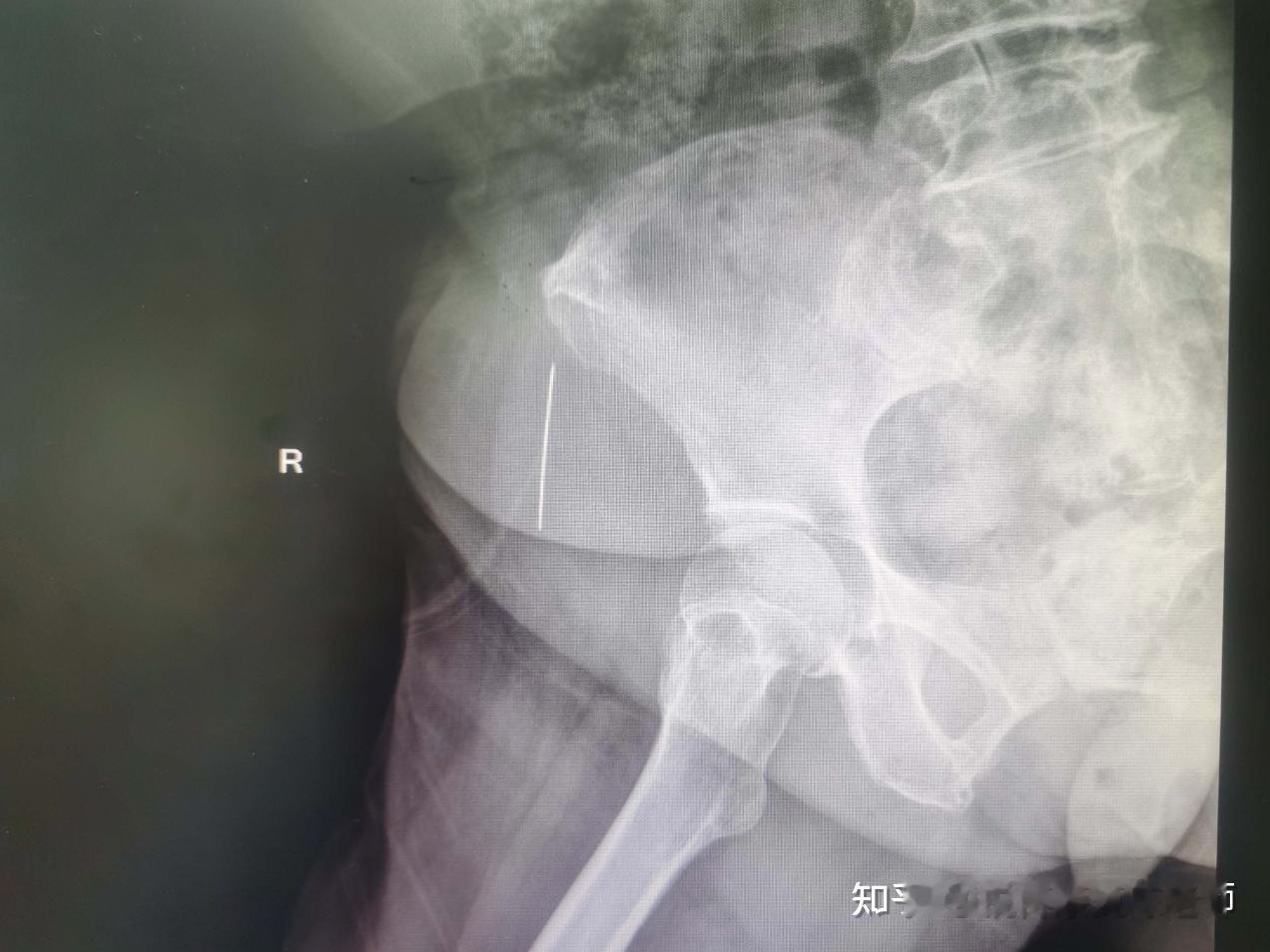 腰痛前两天我看到个新闻，“以为是腰突复发，结果大腿里藏着一根缝衣针”是一位6