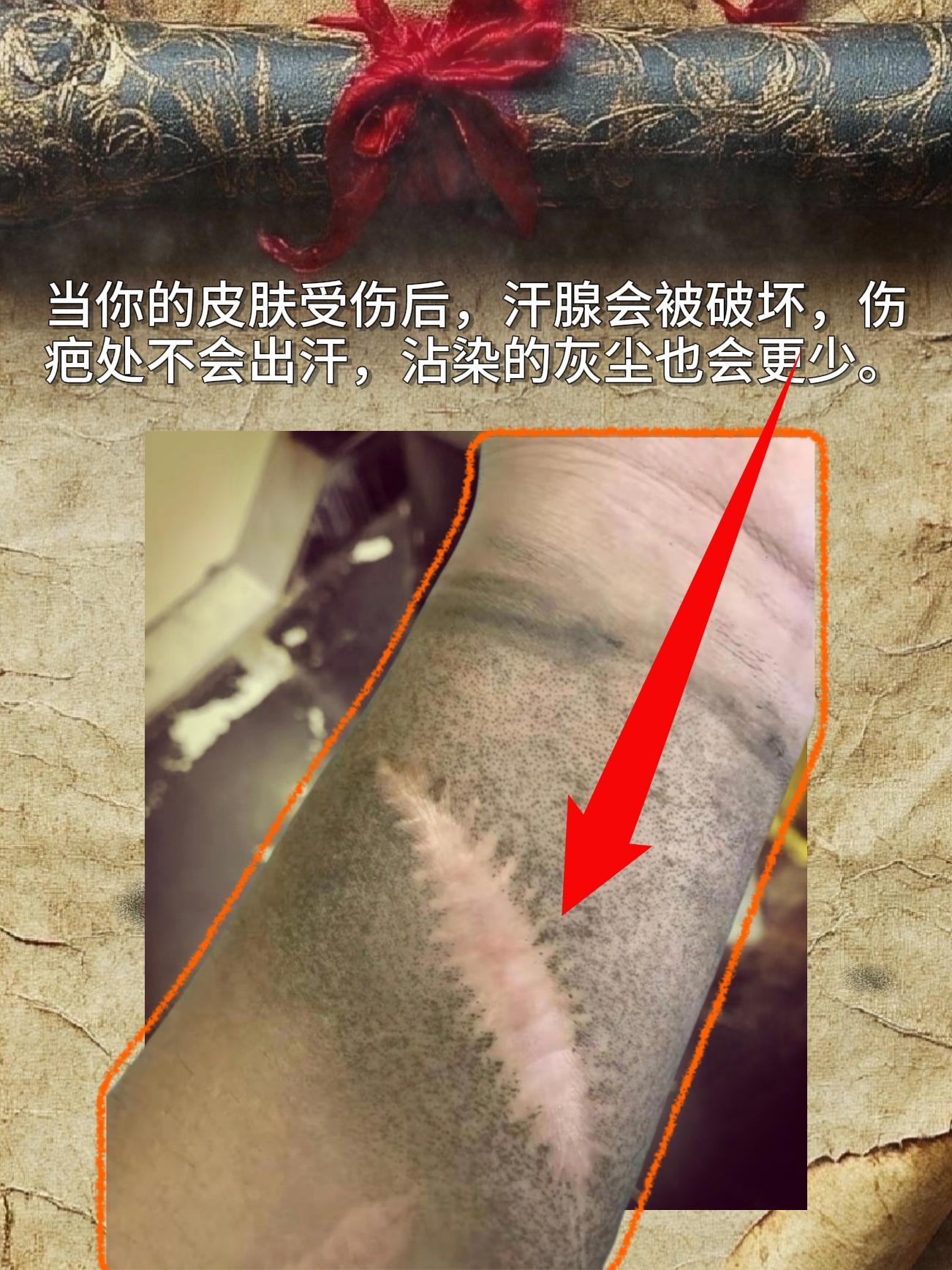 你不知道的冷知识！当你的皮肤受伤后，汗腺会被破坏，伤疤处不会出汗，沾染...