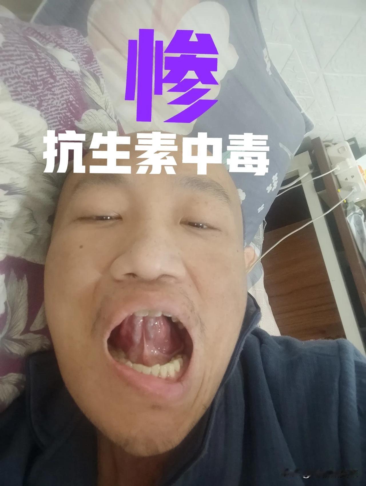 今年的遭遇确实惨。先是五月份双脚得了神经炎，疼痛难忍，八月末的时候打头孢消炎中毒