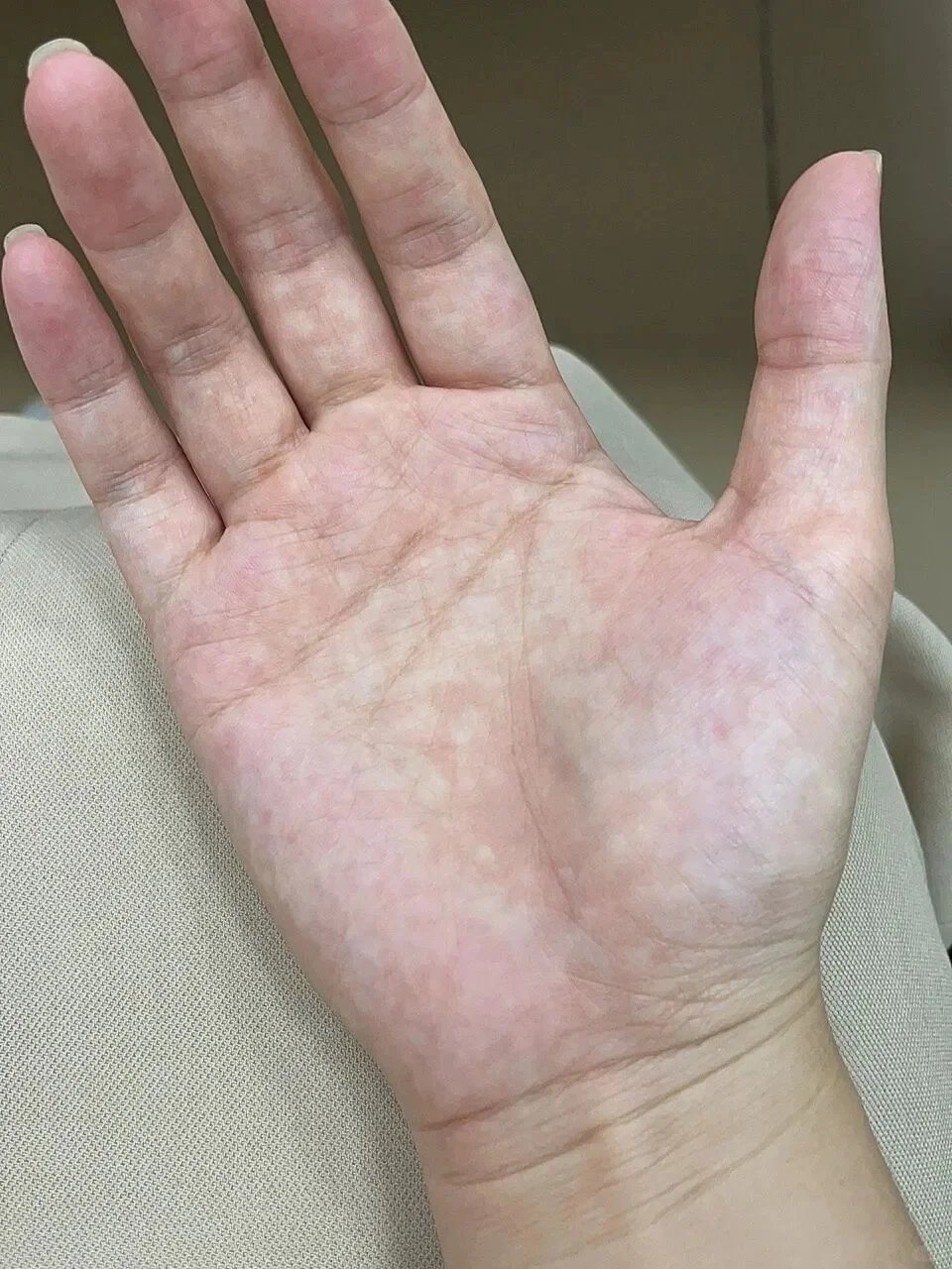 现在才知道雪花手其实是一种病手上总有像雪花一样的斑点把手垂下一会儿，再举起来时，
