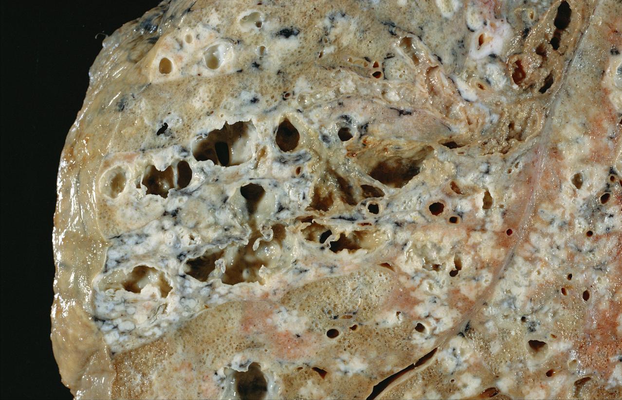 40多岁就已经呼吸衰竭，生命垂危，究其原因就是一个字，作。这个病人是个男性，年