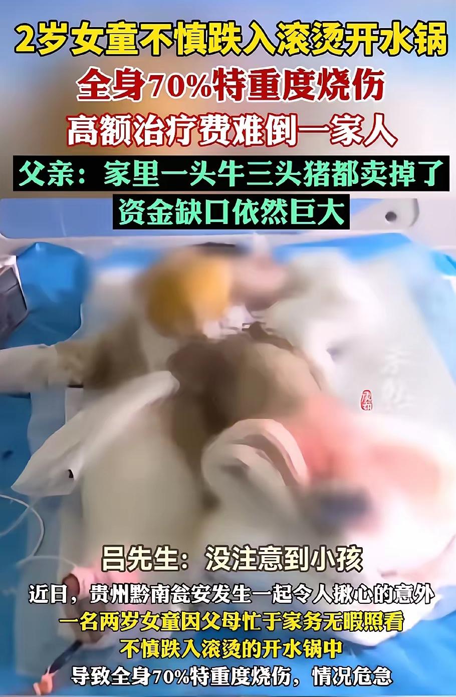 这口锅怕是忘不掉了。贵州山里两岁女童跌进烫猪的开水锅，全身七成皮肤烫得发白。