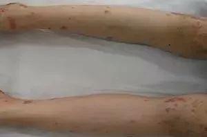 皮肤病、腹痛、关节炎症? 还是小儿过敏性紫癜?