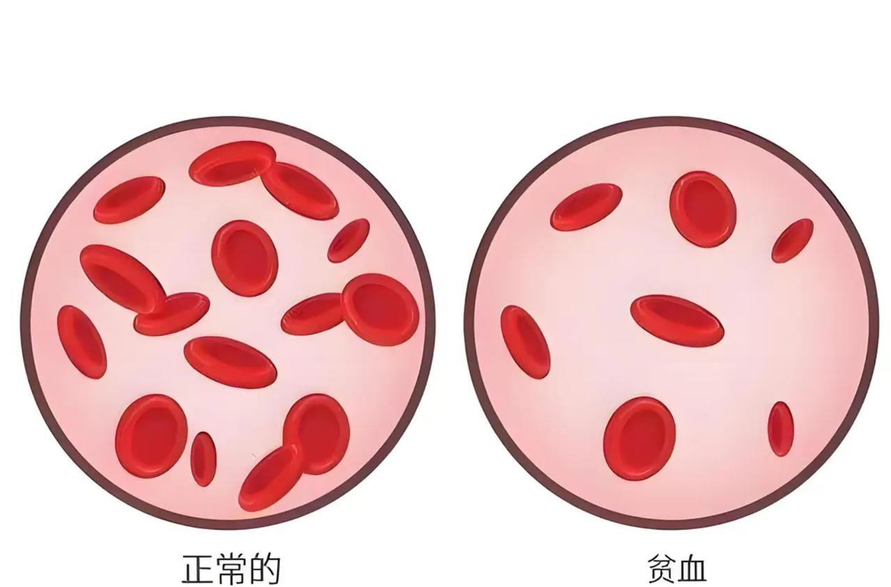 别以为贫血只是“脸色差”，4种常见贫血类型，你不可不知！贫血不是“营养不良”