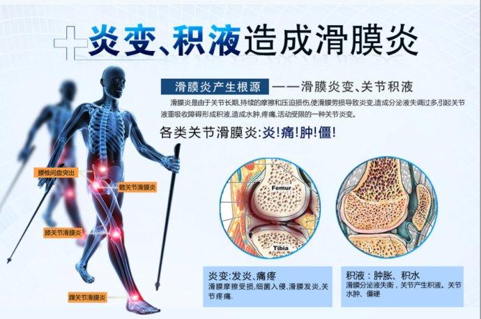 滑膜炎的危害和治疗知多少?