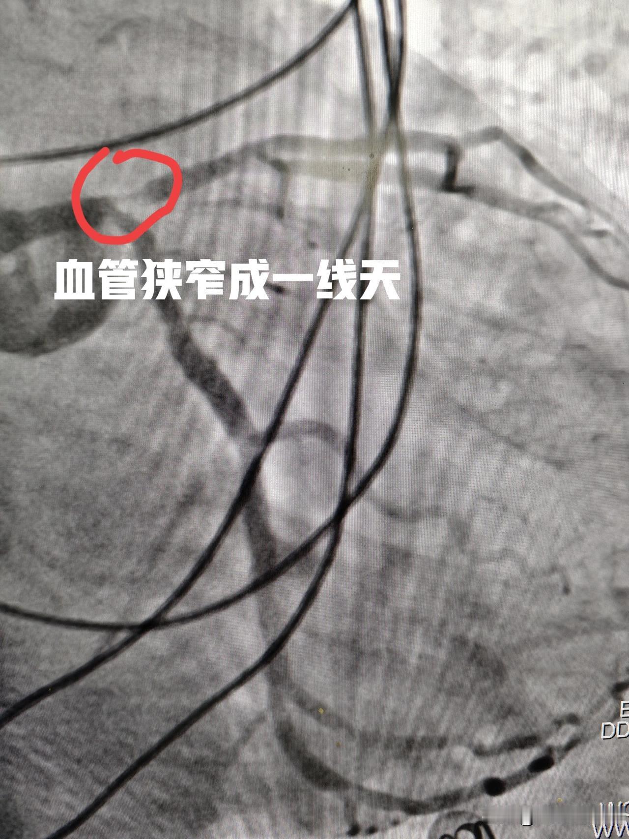 58岁男性，最近2年出现活动后胸闷气短，有时候左侧手臂酸痛，没有引起重视。