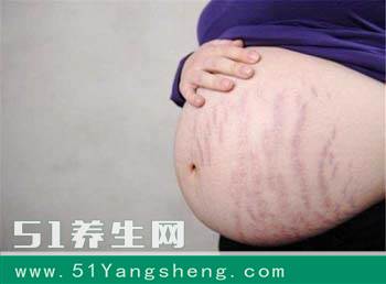 如果孕期有这3种特征, 那么恭喜你, 妊娠纹不会找上你