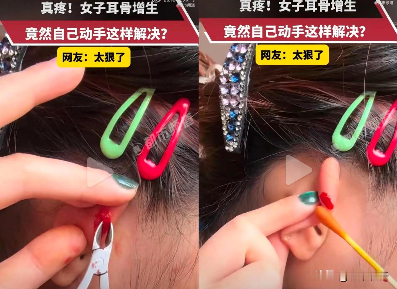湖北一女子因耳骨钉增生出现硬疙瘩，自行用针戳破增生物，再用未消毒的钳子剪除组织并