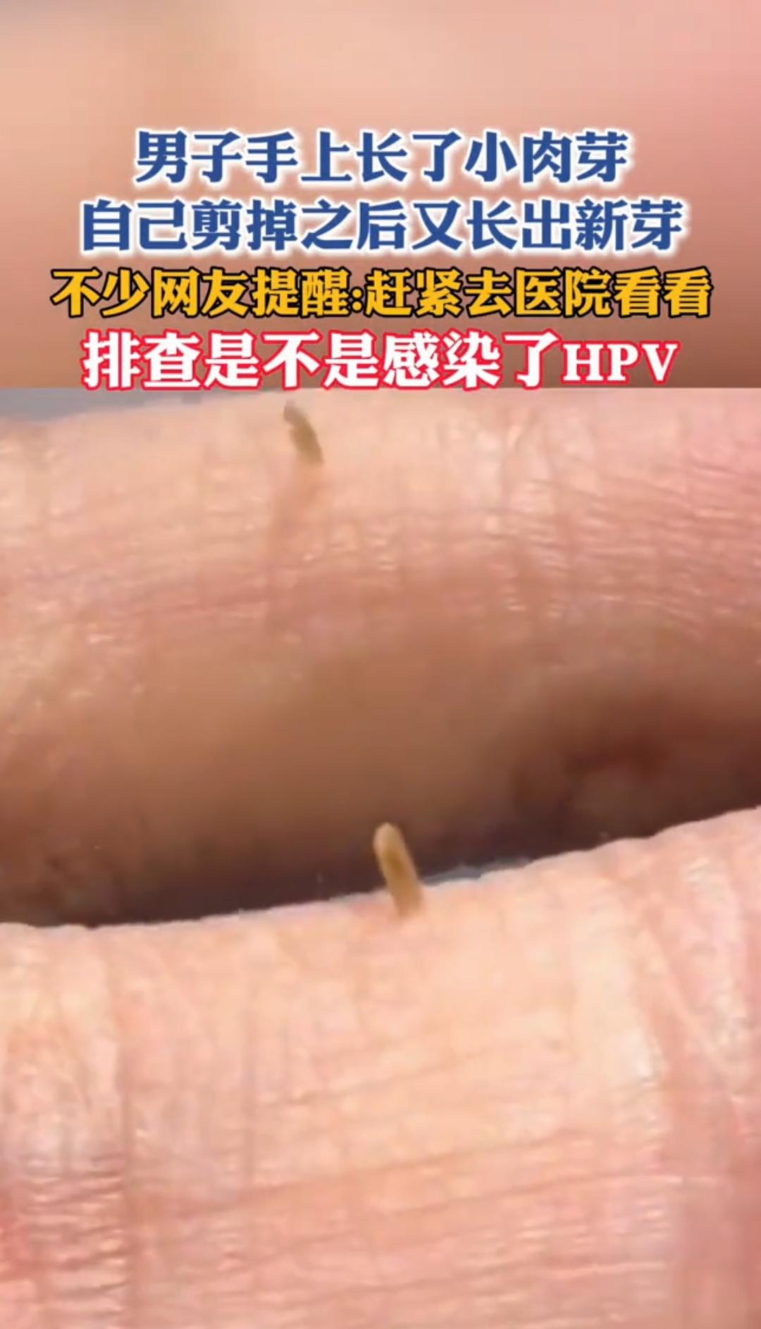手上长小肉芽别乱剪！自行处理风险大，越剪越长还易传染不少人手上会长米粒大小