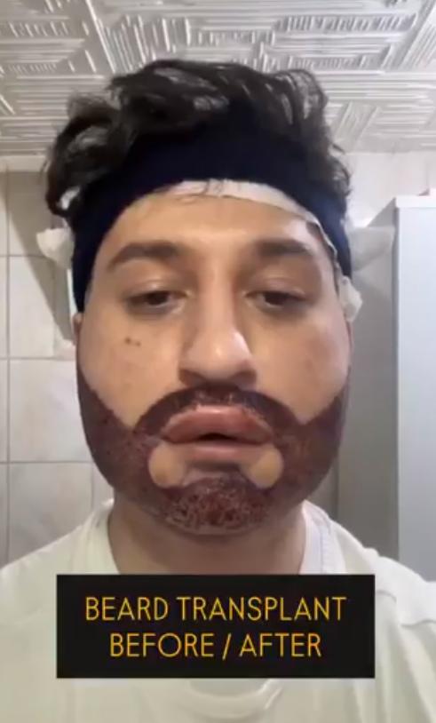 一个土耳其小伙去做了胡子种植手术，结果彻底崩溃。第七天拆纱布后发现胡子假得离谱