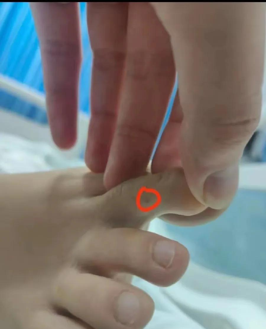 三亚女游客被蛇咬伤的伤口，右脚第二脚趾右侧中间，像针孔一样小，不是对蛇咬治疗很专